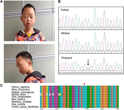 Case Report: Exome and RNA Sequencing Identify a Novel de novo Missense Variant in HNRNPK in a Chinese Patient With Au-Kline Syndrome